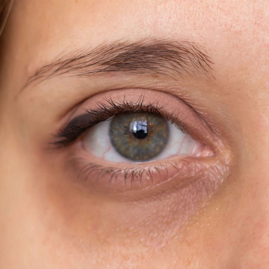 dark undereye